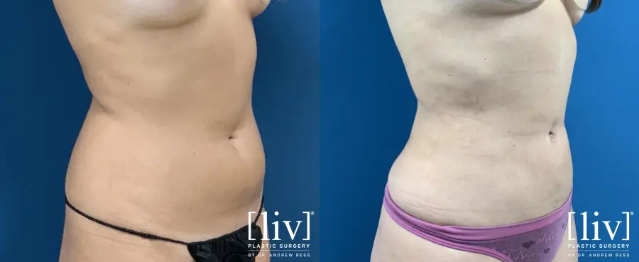 Liposuction: Patient 23 - Before and After 4