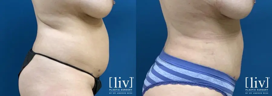 Liposuction: Patient 8 - Before and After 5