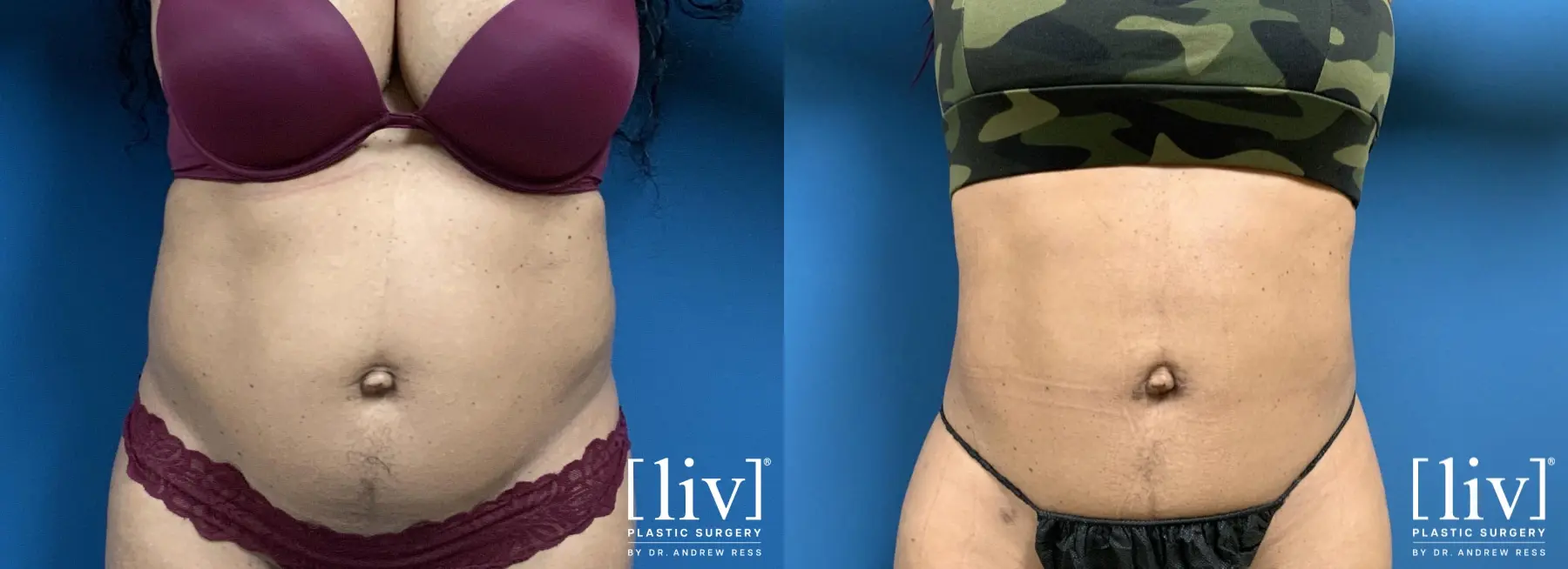 Liposuction: Patient 8 - Before and After  