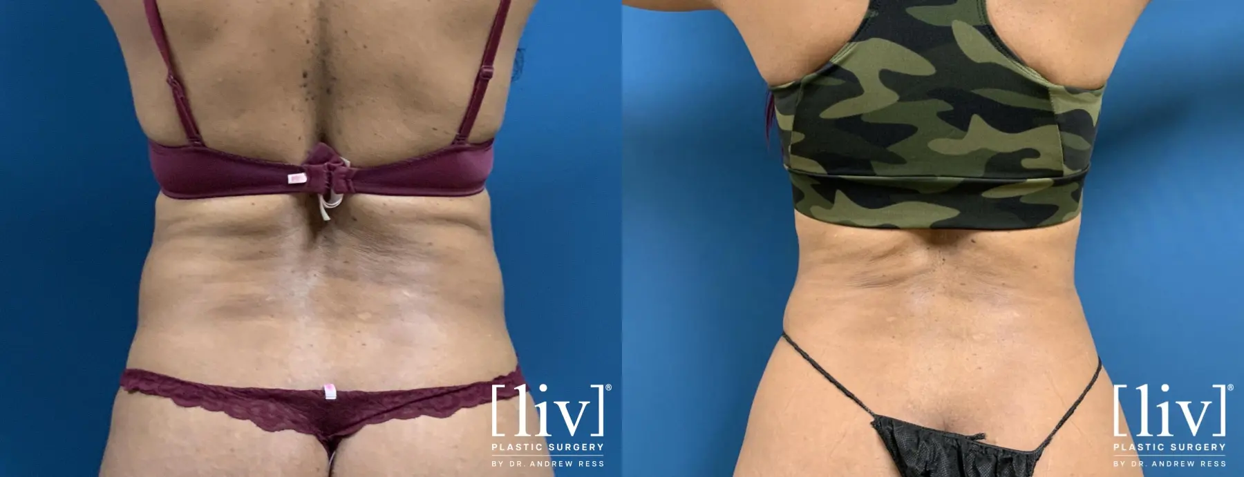 Liposuction: Patient 8 - Before and After 4