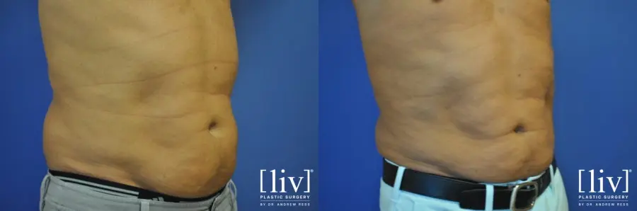 Liposuction: Patient 2 - Before and After 2