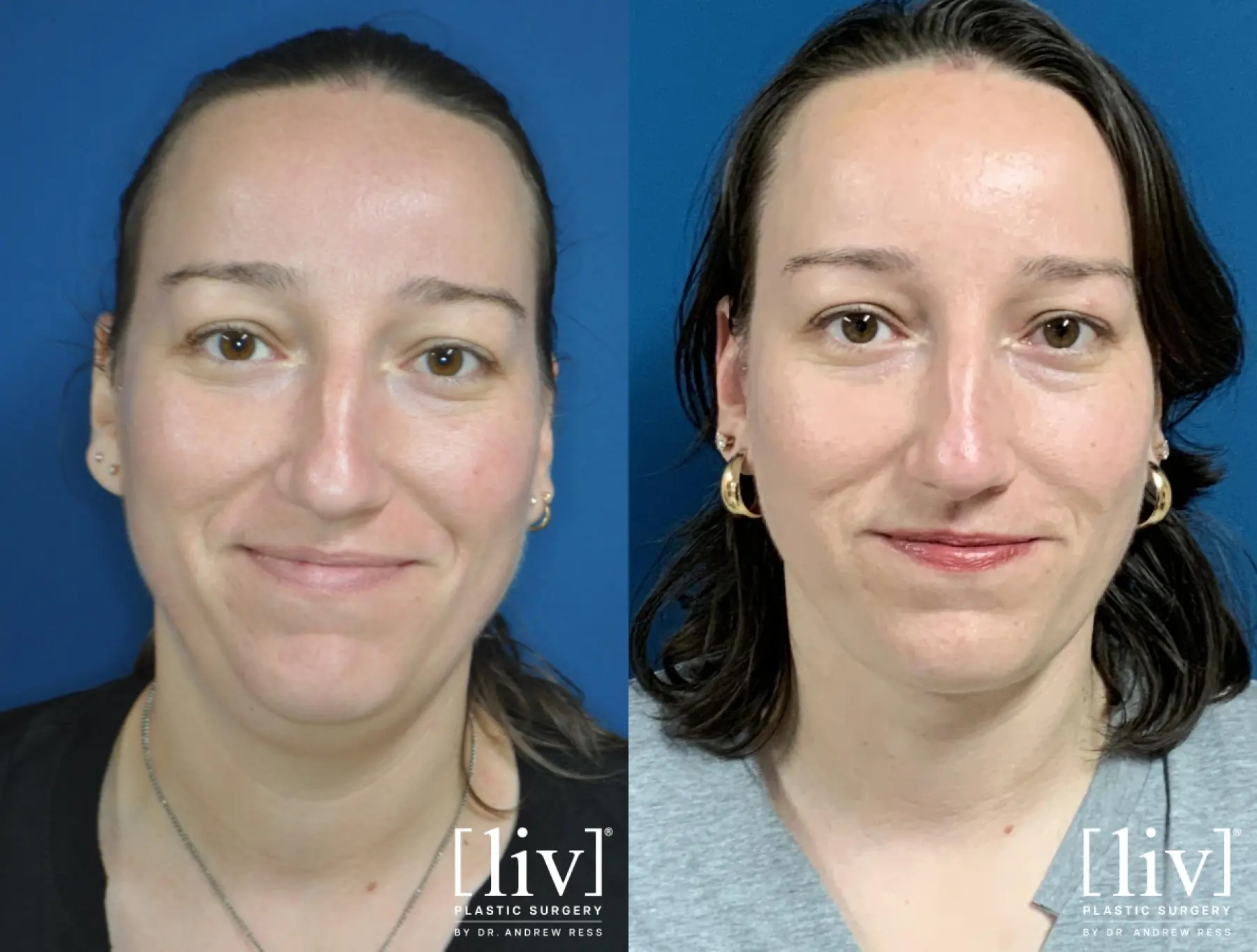Liposuction Of The Neck: Patient 2 - Before and After 1
