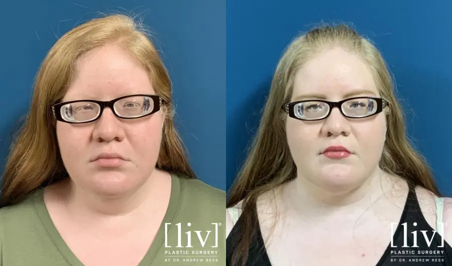 Liposuction Of The Neck: Patient 4 - Before and After 3