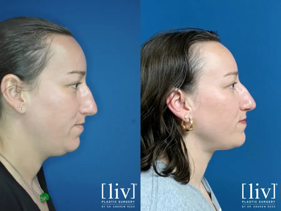 Liposuction Of The Neck: Patient 2 - Before and After 2