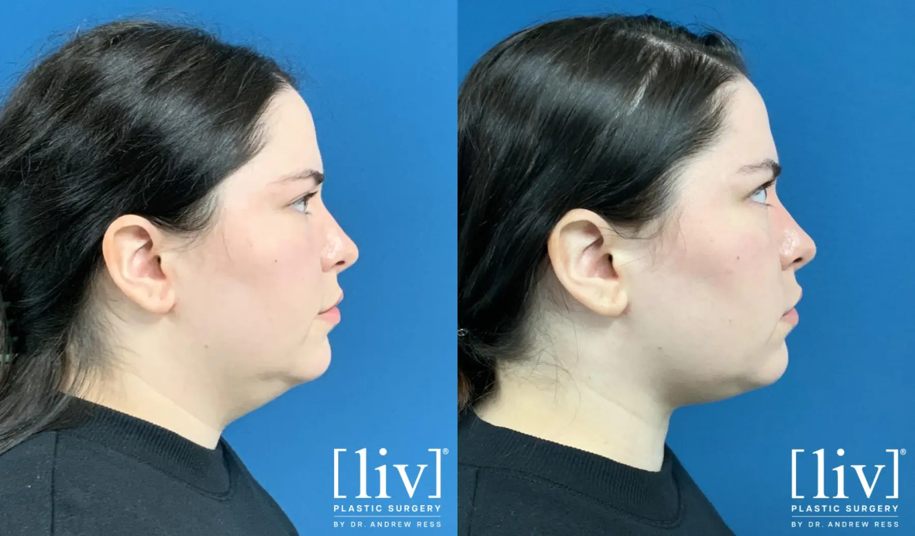 Liposuction Of The Neck: Patient 5 - Before and After 3