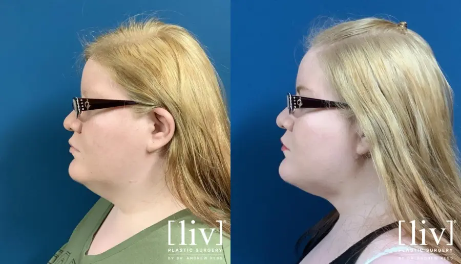 Liposuction Of The Neck: Patient 4 - Before and After 2