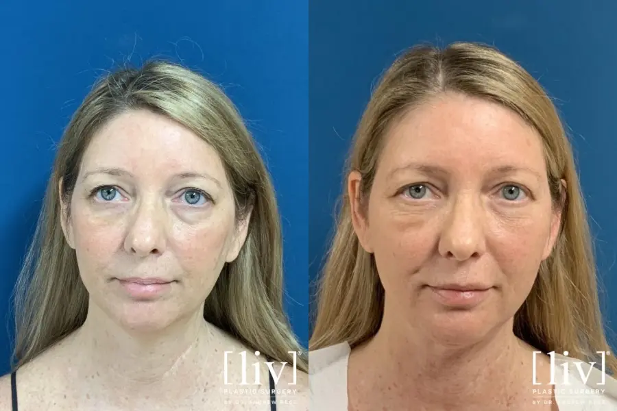 Liposuction Of The Neck: Patient 2 - Before and After 3