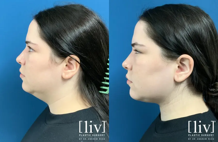 Liposuction Of The Neck: Patient 5 - Before and After 2
