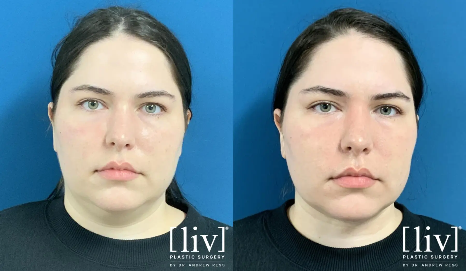 Liposuction Of The Neck: Patient 5 - Before and After  