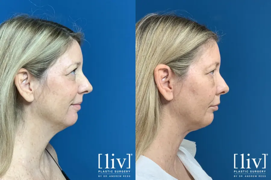 Liposuction Of The Neck: Patient 2 - Before and After  