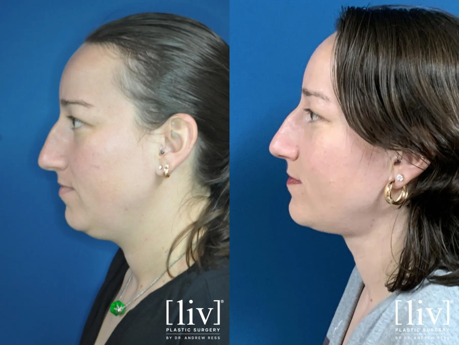 Liposuction Of The Neck: Patient 2 - Before and After 3