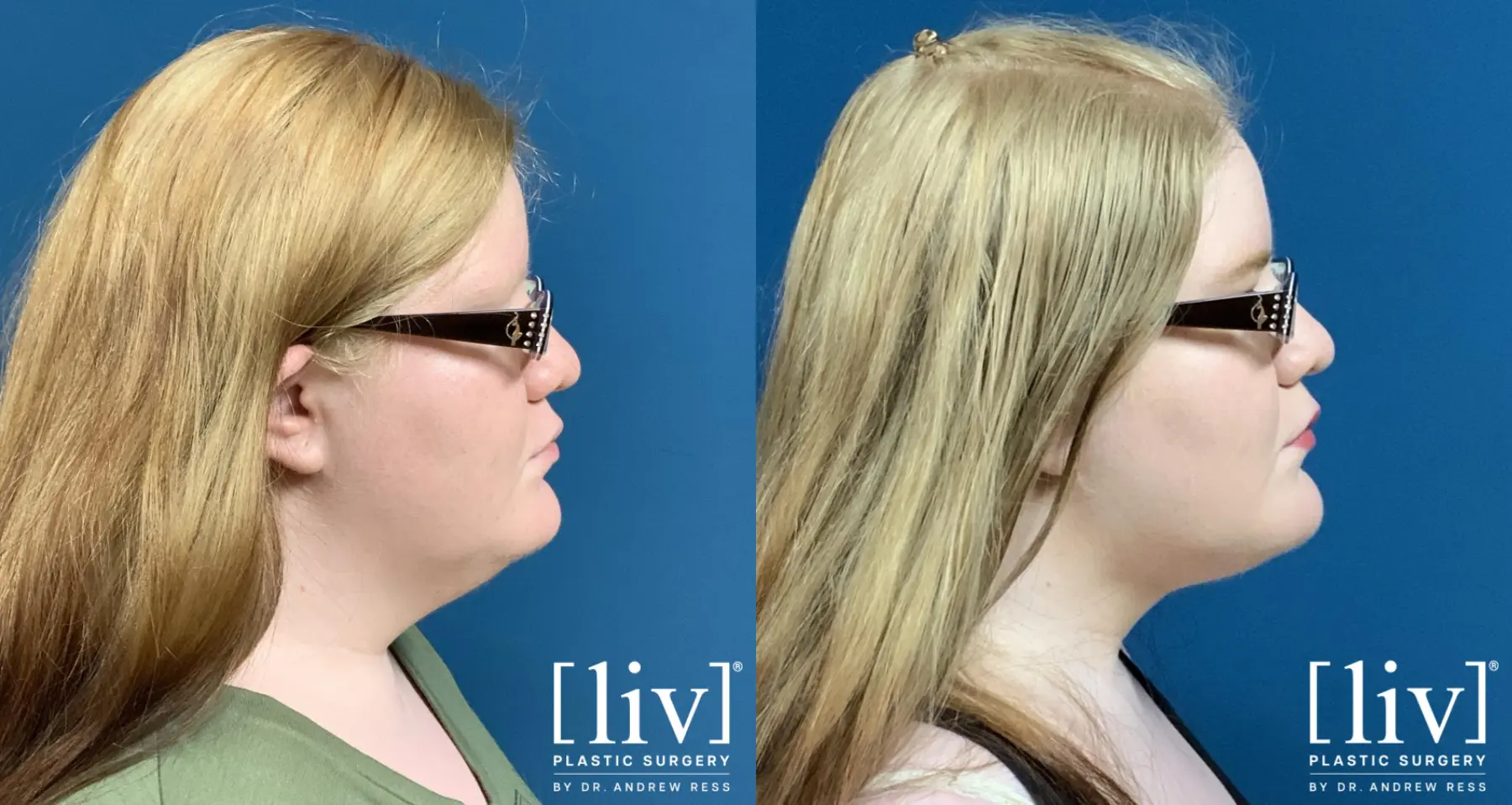 Liposuction Of The Neck: Patient 4 - Before and After  