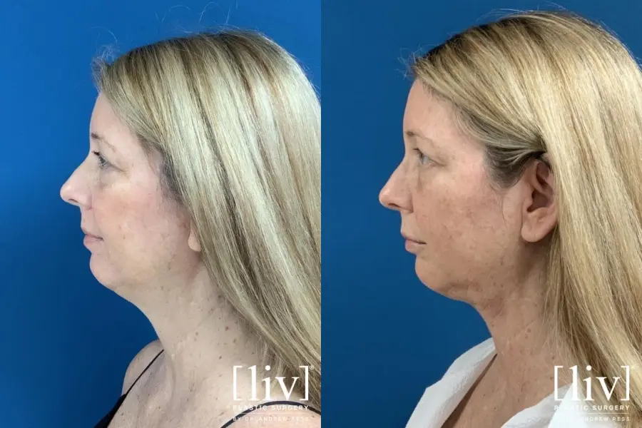 Liposuction Of The Neck: Patient 3 - Before and After 2