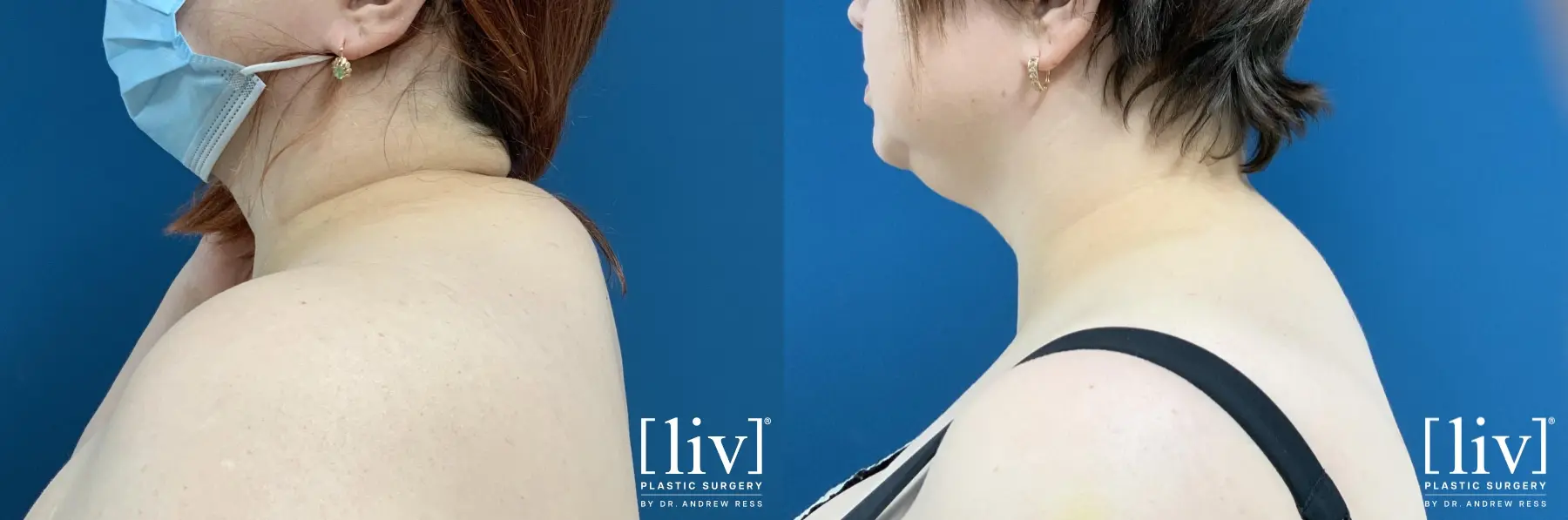 Posterior Neck Liposuction - Before and After 2
