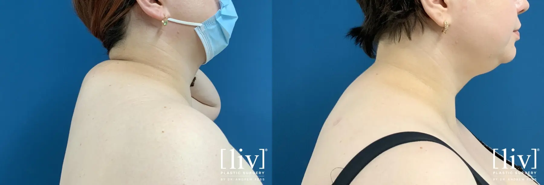 Posterior Neck Liposuction - Before and After  