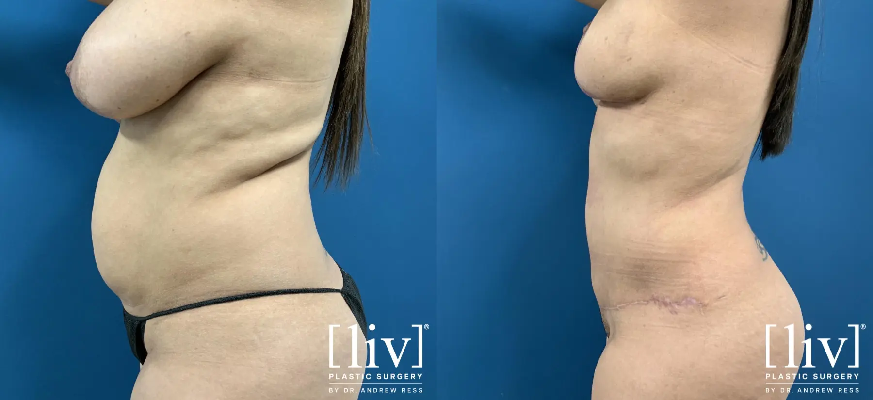 Mommy Makeover: Patient 3 - Before and After 3