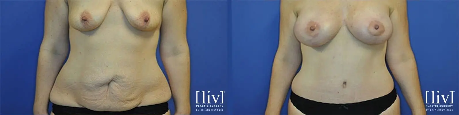 Mommy Makeover: Patient 1 - Before and After 1