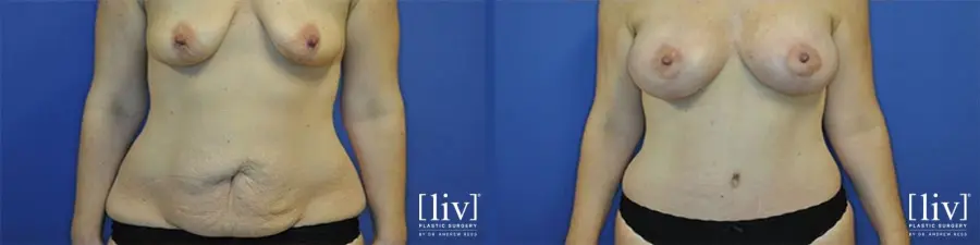 Mommy Makeover: Patient 1 - Before and After 1