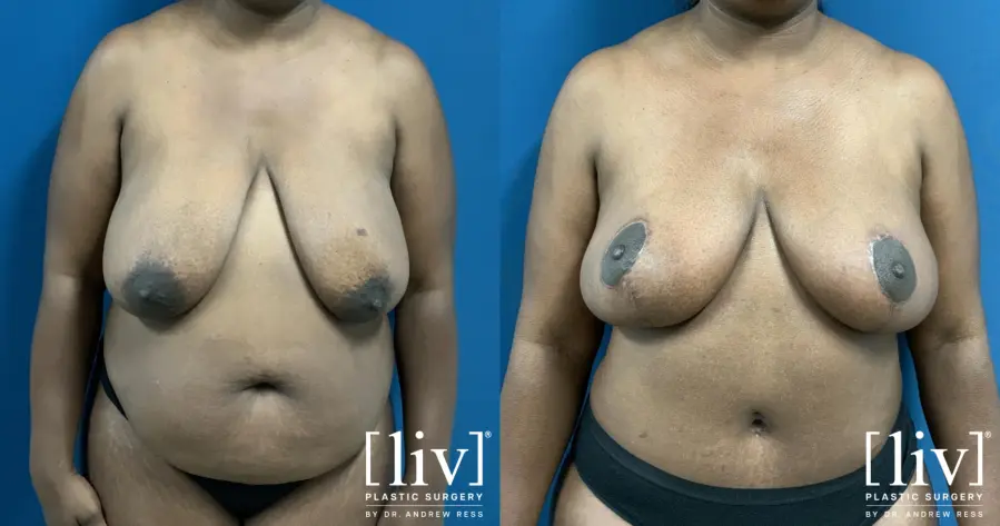 Mommy Makeover: Patient 4 - Before and After  