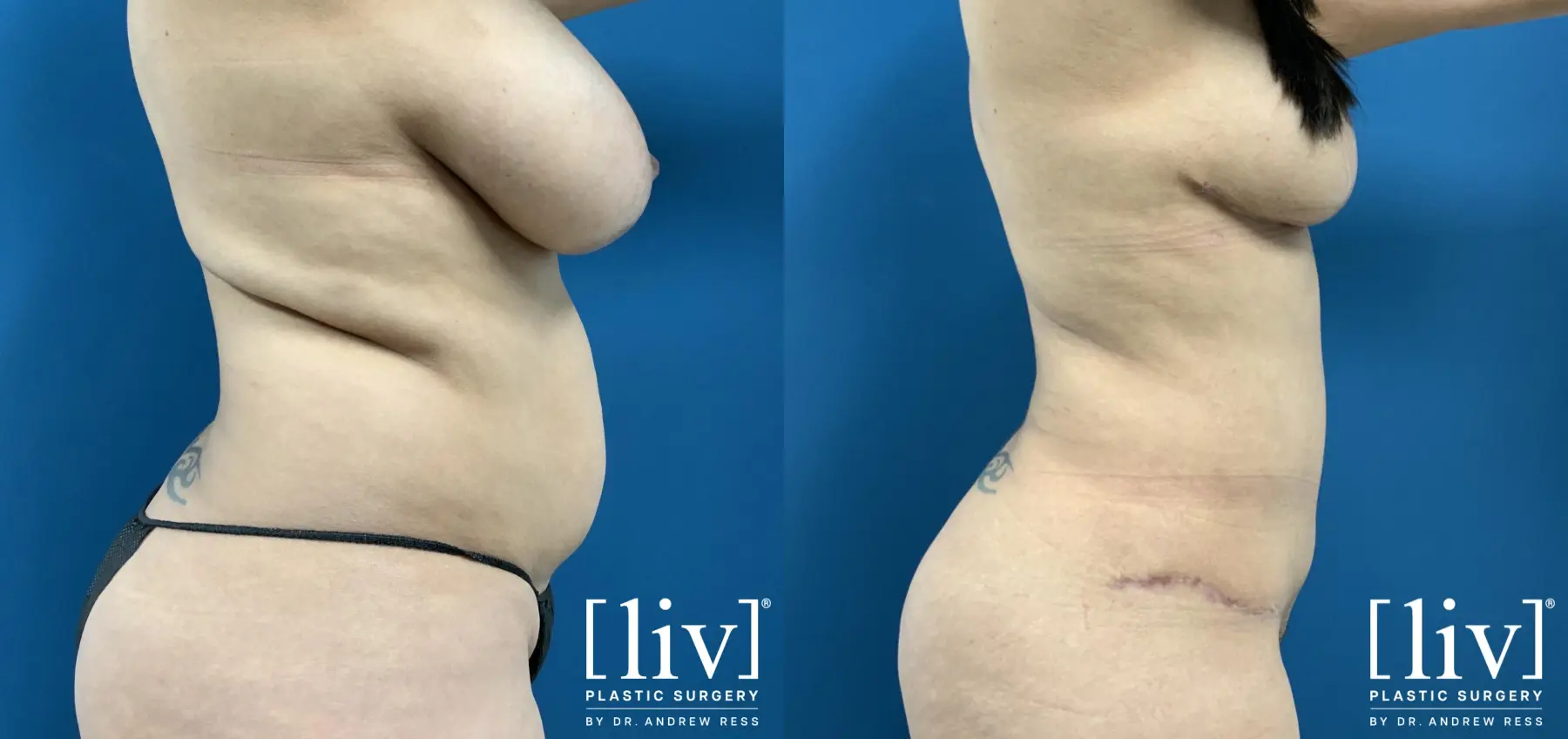 Mommy Makeover: Patient 3 - Before and After 5