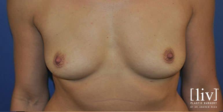 Breast Augmentation: Patient 8 - Before 