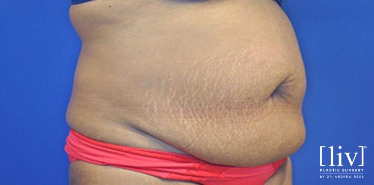 Lipoabdominoplasty - Before 1