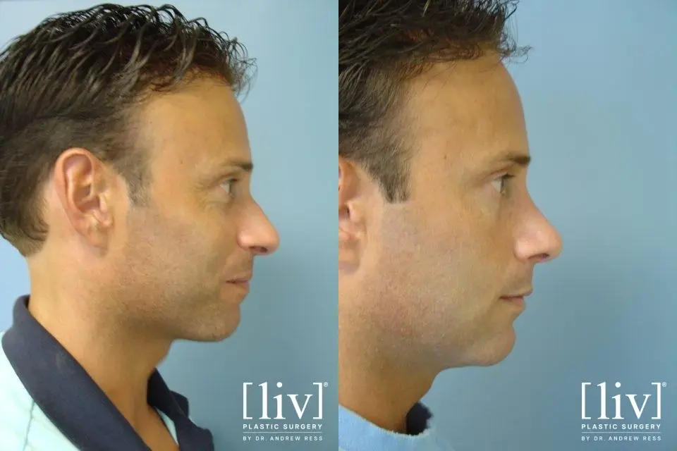 Rhinoplasty: Patient 21 - Before and After 5