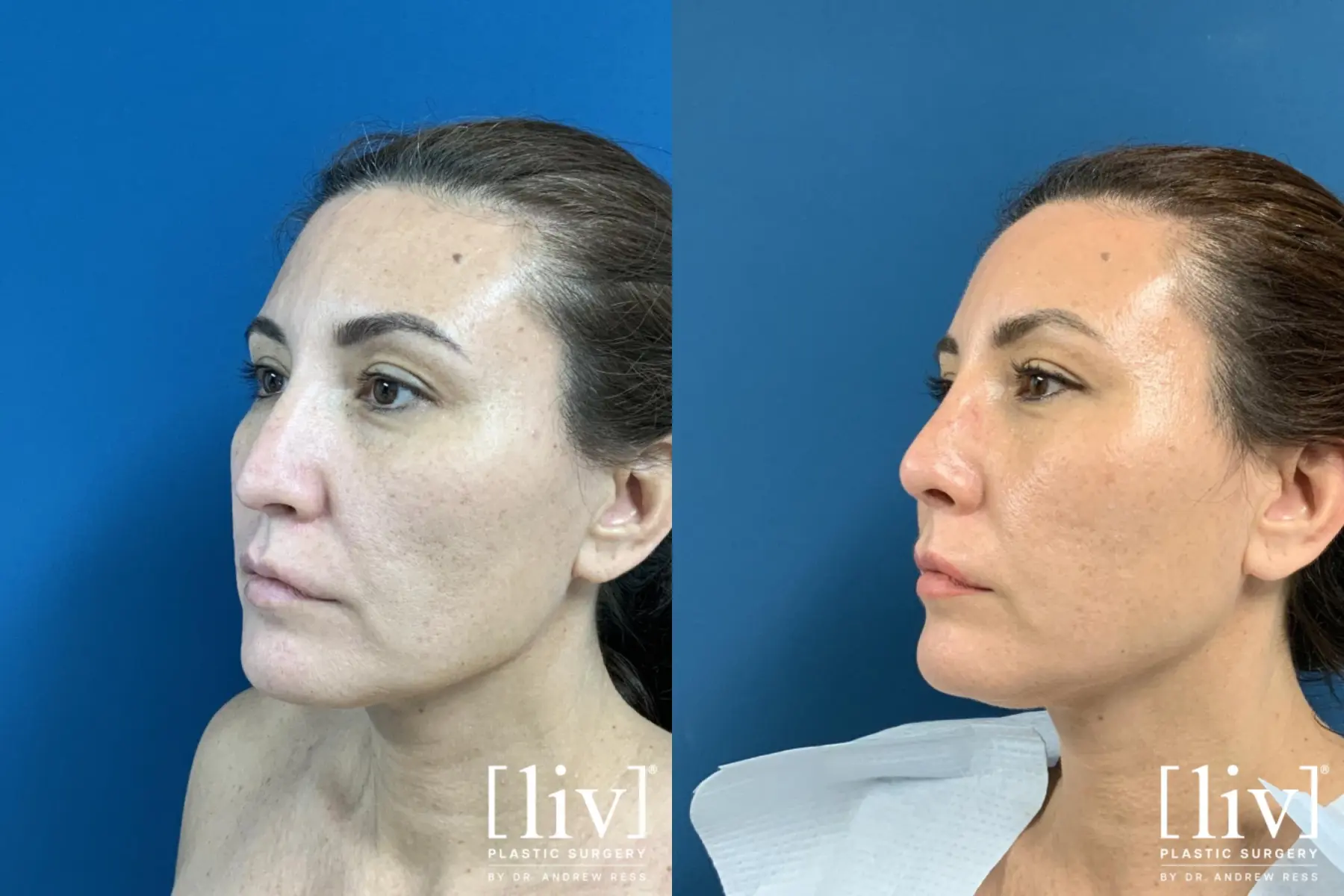 Rhinoplasty: Patient 7 - Before and After 2