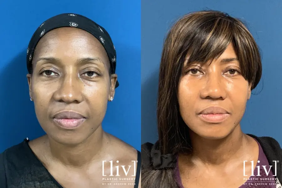 Rhinoplasty: Patient 17 - Before and After 1
