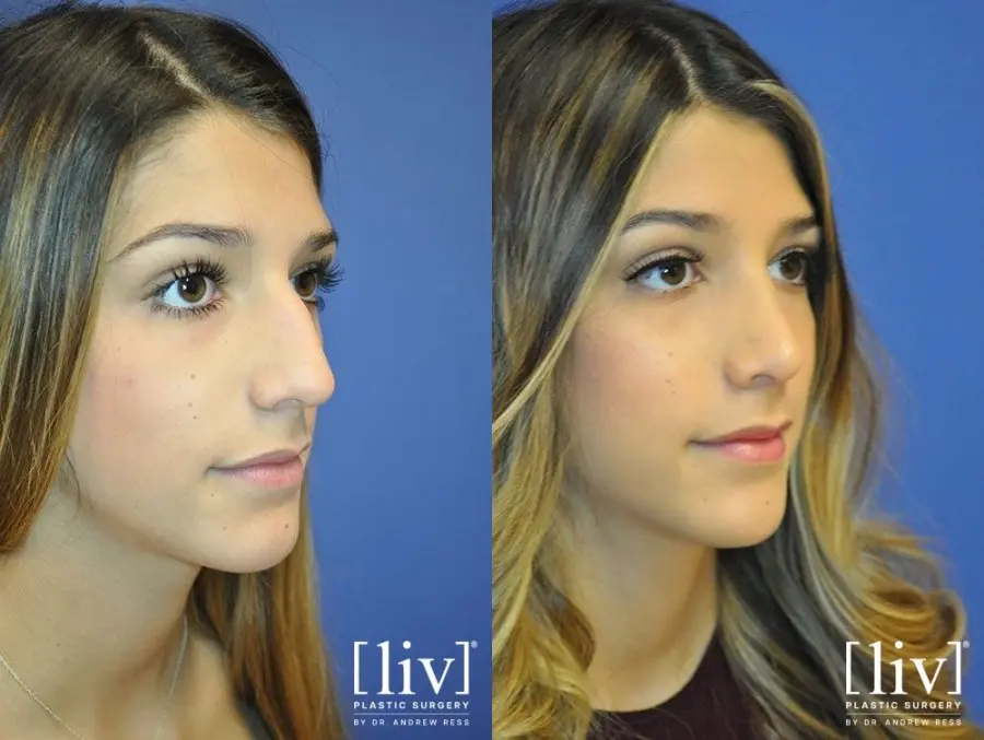 Rhinoplasty: Patient 15 - Before and After 2