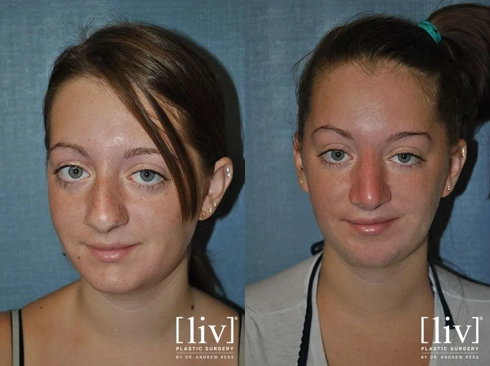 Rhinoplasty: Patient 11 - Before and After 1
