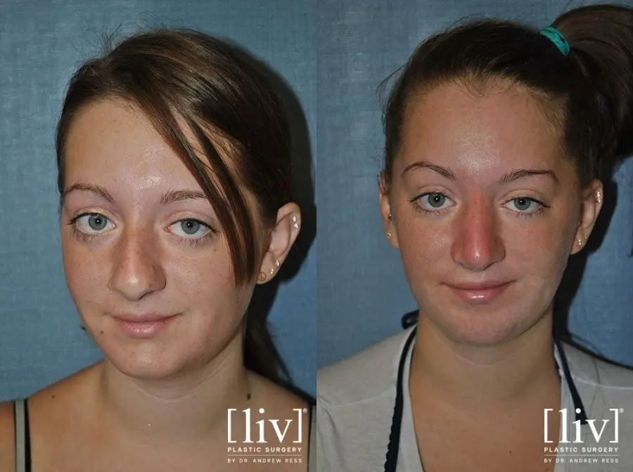 Rhinoplasty: Patient 3 - Before and After 1