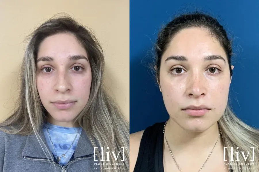 Rhinoplasty: Patient 18 - Before and After 3