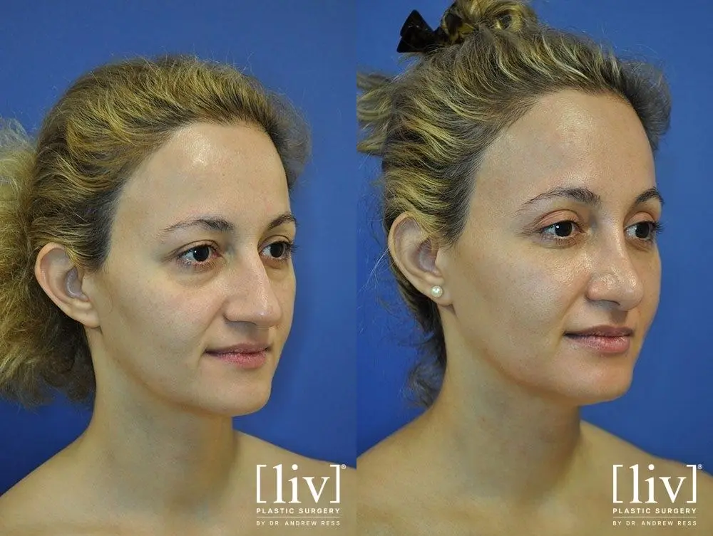 Rhinoplasty: Patient 13 - Before and After 2