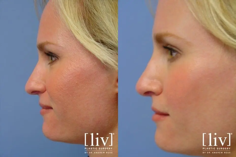 Rhinoplasty: Patient 22 - Before and After 3