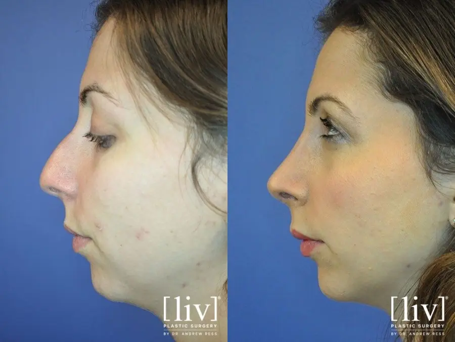 Rhinoplasty: Patient 8 - Before and After 3