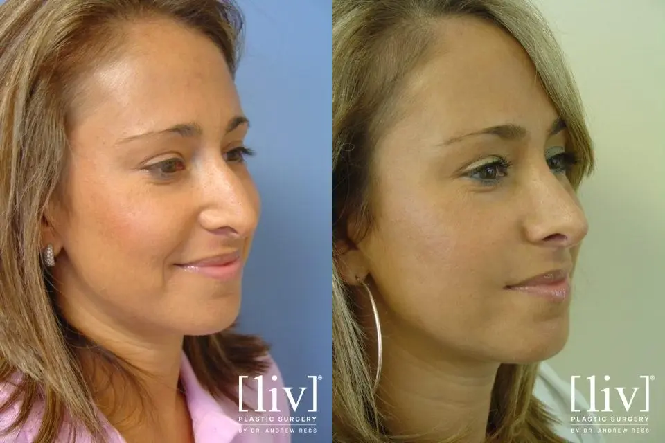 Rhinoplasty: Patient 12 - Before and After 2