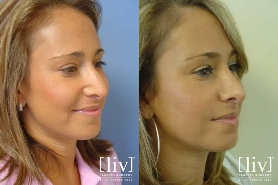 Rhinoplasty: Patient 5 - Before and After 2