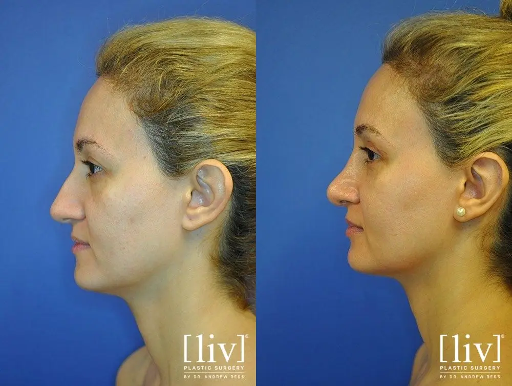 Rhinoplasty: Patient 13 - Before and After 5