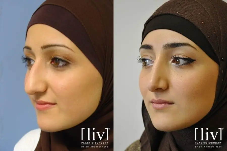 Rhinoplasty: Patient 1 - Before and After 2