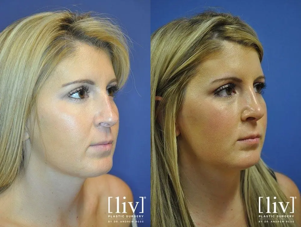 Rhinoplasty: Patient 18 - Before and After 2
