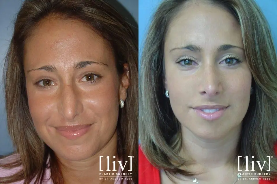 Rhinoplasty: Patient 12 - Before and After 1