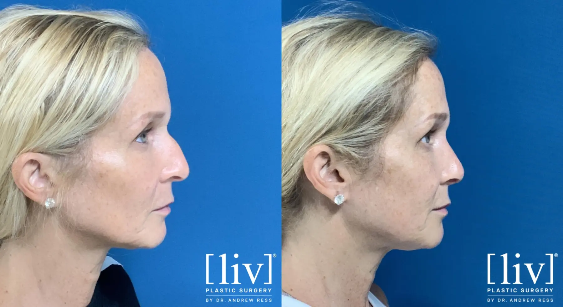 Rhinoplasty: Patient 3 - Before and After 2