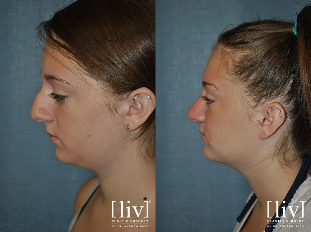 Rhinoplasty: Patient 11 - Before and After 3