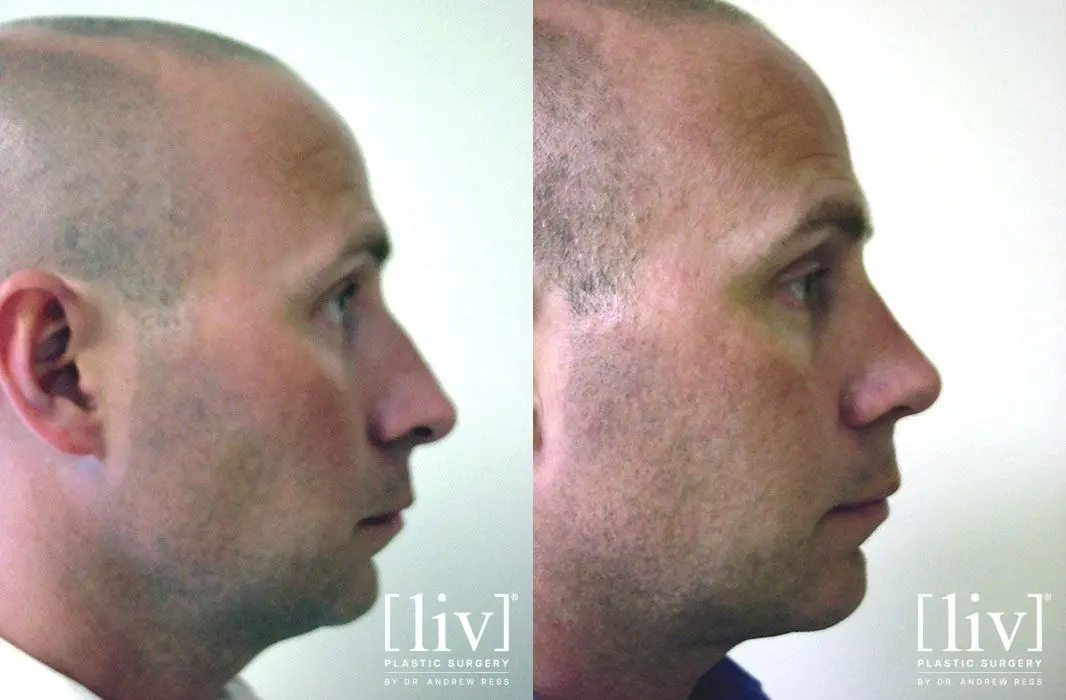 Rhinoplasty: Patient 18 - Before and After 3