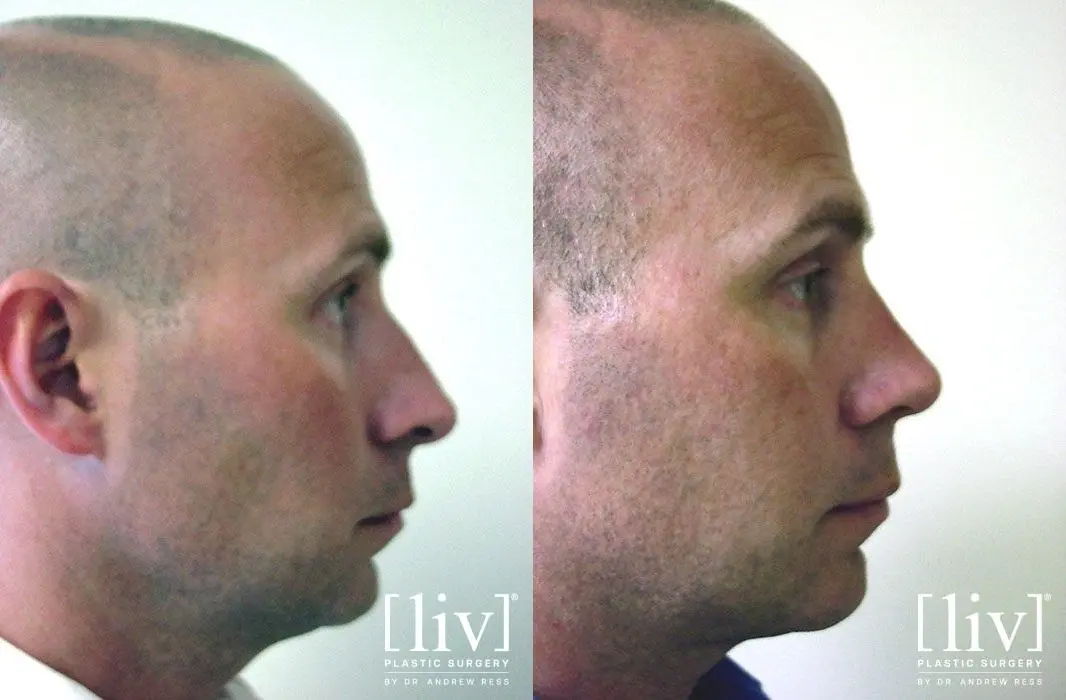 Rhinoplasty: Patient 20 - Before and After 3