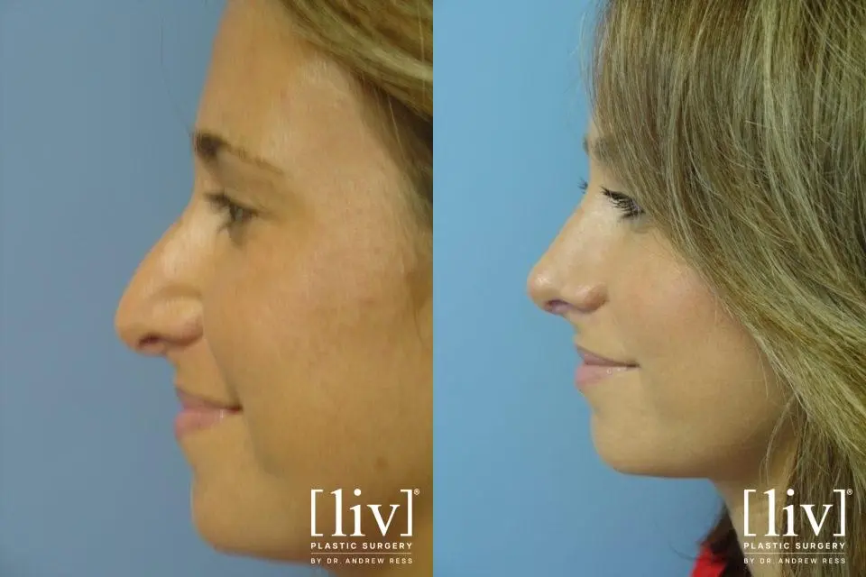 Rhinoplasty: Patient 12 - Before and After 3