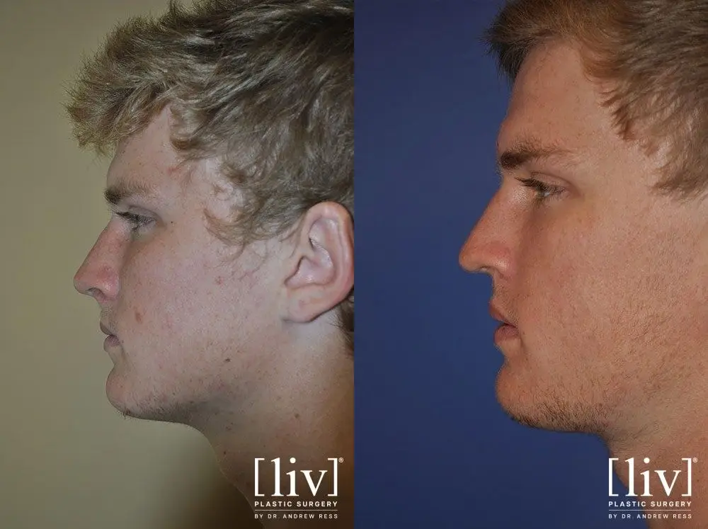 Rhinoplasty: Patient 13 - Before and After 3