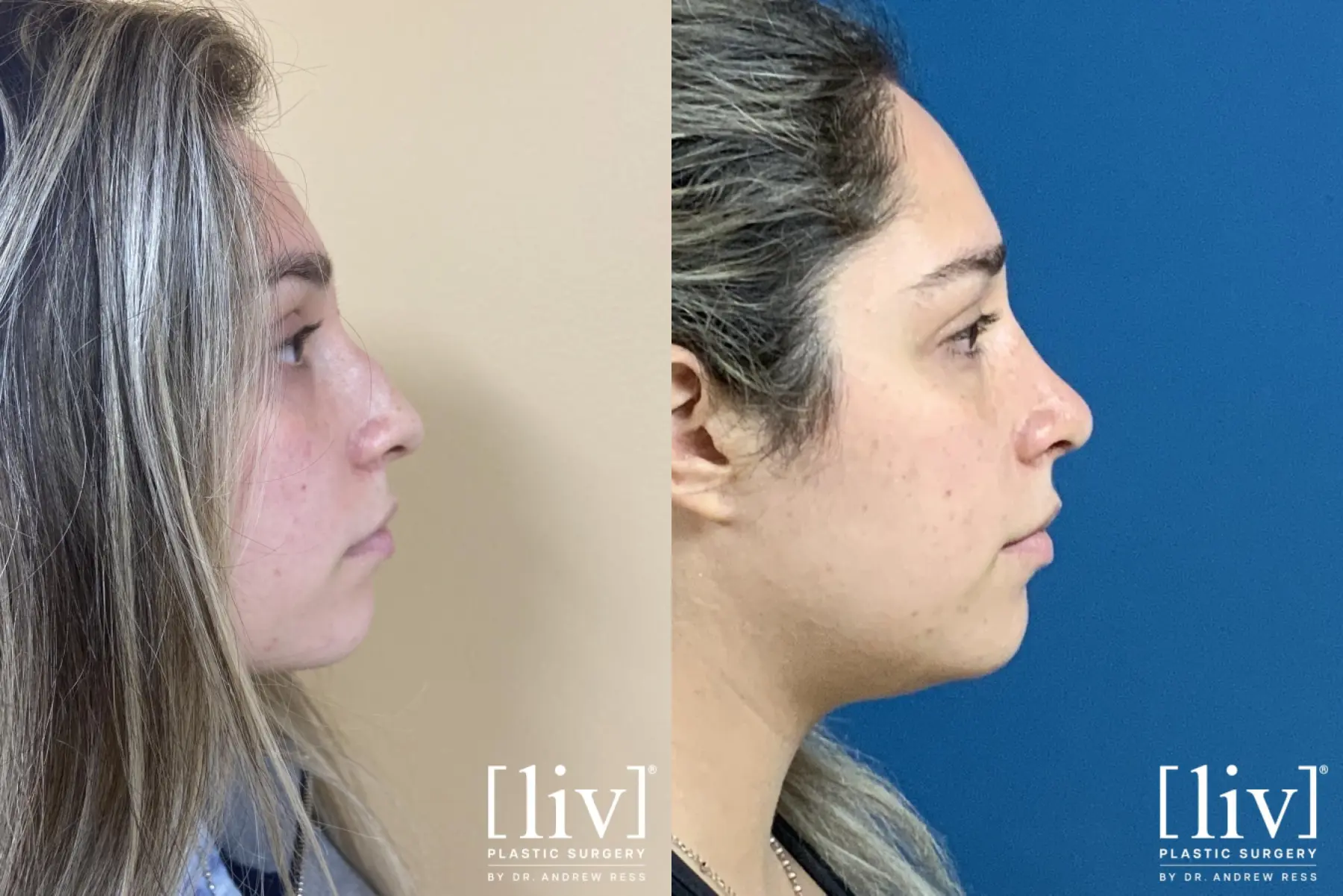 Rhinoplasty: Patient 2 - Before and After 1