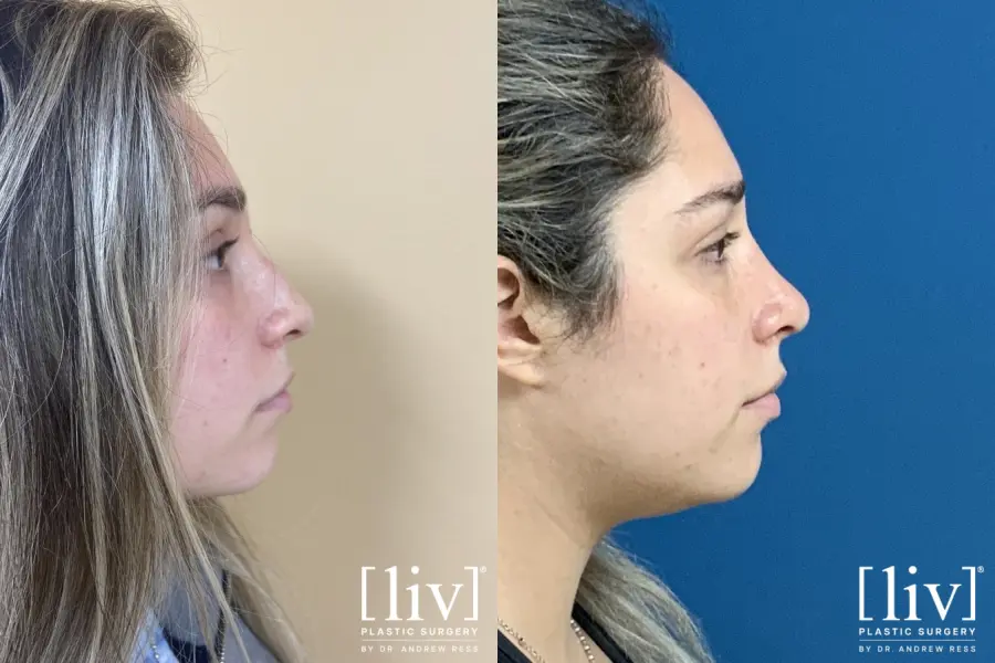 Rhinoplasty: Patient 18 - Before and After 1